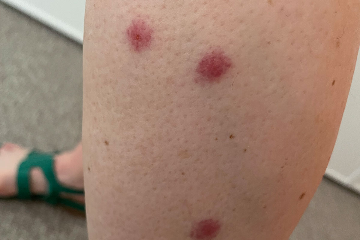 Bitten by mosquitoes
